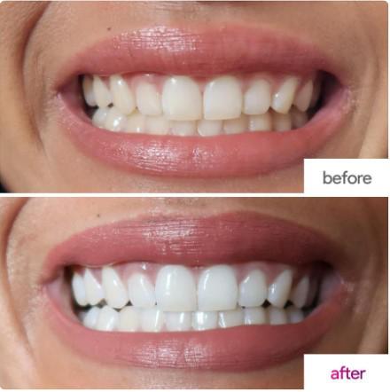  Шүд цайруулах багц - Teeth Whitening Kit