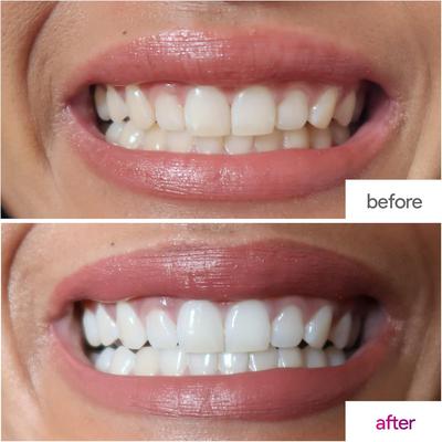 Teeth whitening kit + refill gel (шүд цайруулах багц + цэнэглэгч гель)